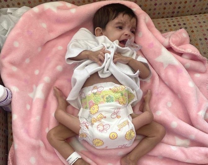 Yemeni parasitic twins Aisha and Ahmed. (SPA)