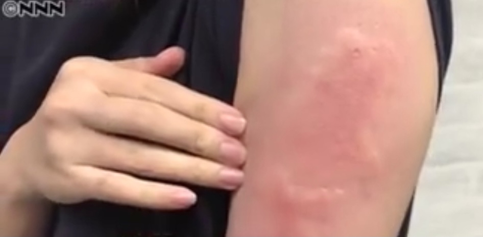 The term ‘Moderna arm’ is spreading in Japan to describe cases where characteristic side effects appear a few days after vaccination with Moderna's coronavirus vaccine. (Photos: Courtesy of NNN tv)