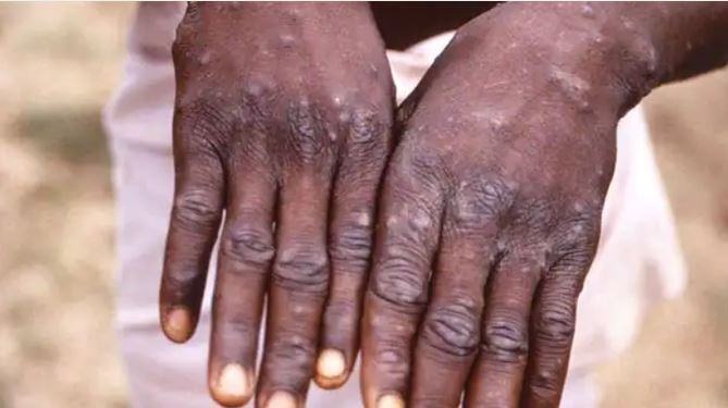People who have received a vaccination against smallpox are “highly likely” to be safe from getting infected with monkeypox. (Reuters)