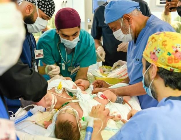 Earlier examinations showed the twin girls share a liver and intestines and are suspected to be attached by a heart membrane. (SPA)