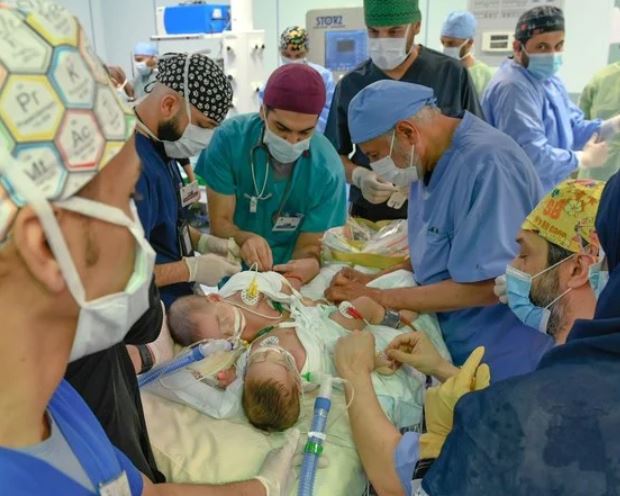 Earlier examinations showed the twin girls share a liver and intestines and are suspected to be attached by a heart membrane. (SPA)