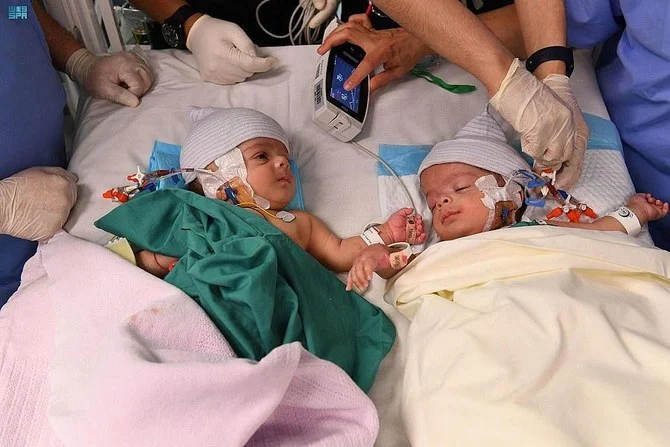 Salman and Abdullah, twins from Yemen, were born joined at the pelvis and abdomen. (SPA)