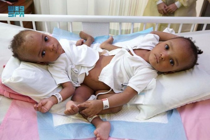 Conjoined twins Hassana and Hassina, who were born in Kaduna, Nigeria on January 12 last year share the abdomen, pelvis, liver, intestines, urinary and reproductive system and pelvic bones. (SPA)