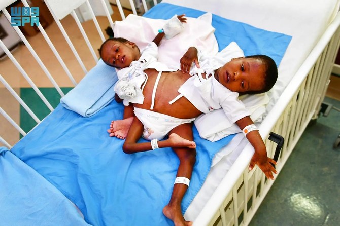 Conjoined Tanzanian twins Hassan and Hussien. (SPA)