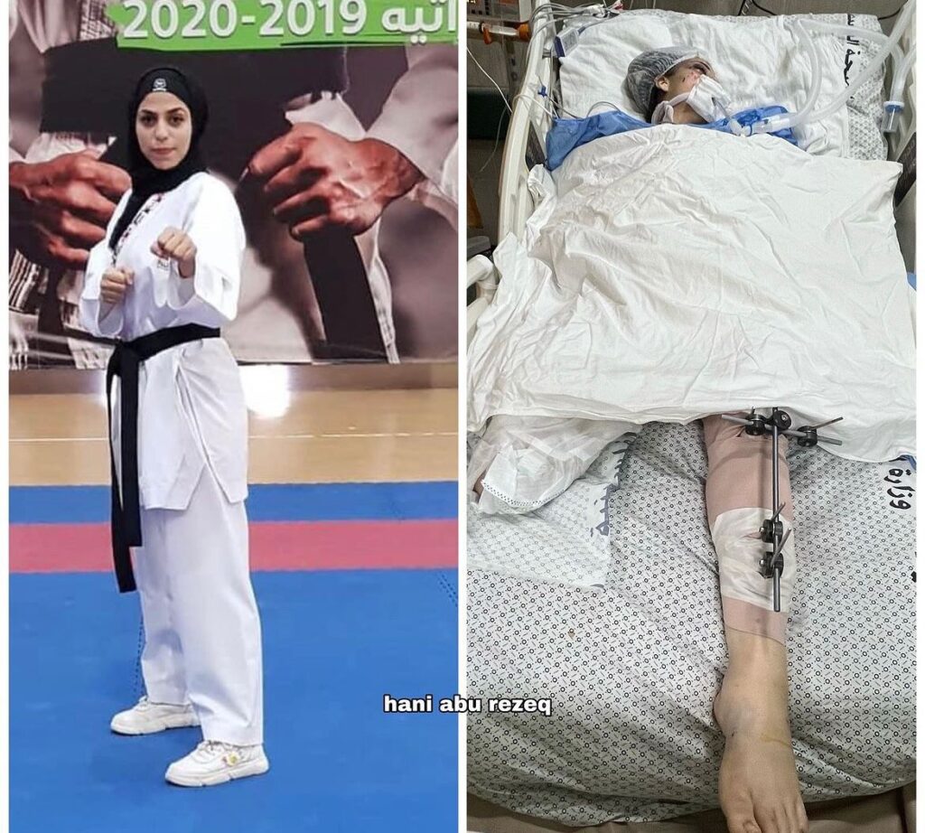 On Dec. 18, Abu Samra’s family house in the Al-Nuseirat refugee camp was bombed, causing her right leg to get amputated as well as a serious head injury. (Screengrab)