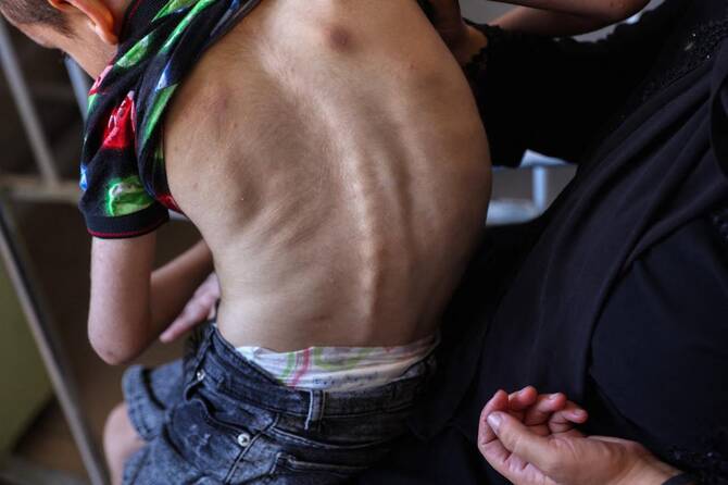 Palestinian boy suffering from malnutrition receives care at the Kamal Adwan hospital in Beit Lahia in the northern Gaza Strip on July 2, 2024. (File/AFP)