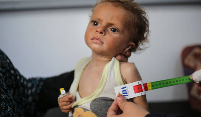 A malnourished Palestinian child is examined at Al-Awda hospital in the Nuseirat refugee camp in the central Gaza Strip on June 30, 2025. (AFP)