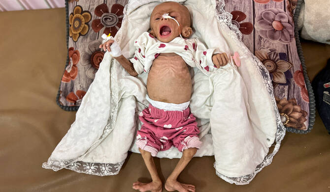 Zainab Abu Haleeb, a five-month-old Palestinian girl diagnosed with malnutrition, according to medics, lies on a bed as she receives treatment at Nasser hospital in Khan Younis, in the southern Gaza Strip July 15, 2025. (REUTERS)