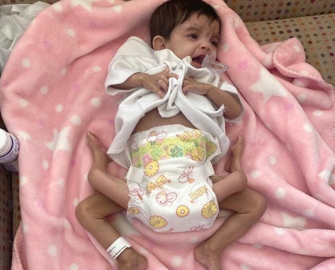 イエメンの寄生双生児「アイシャ・アフマド」（SPA）