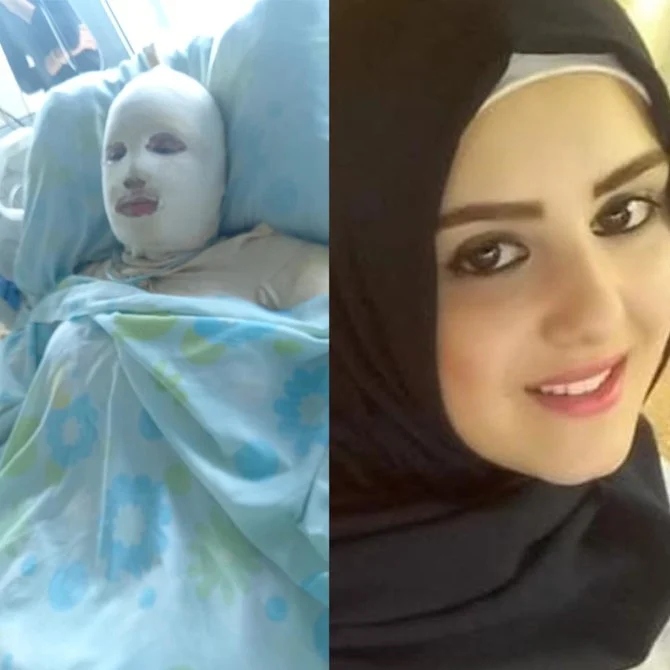 夫に火をつけられ全身にやけどを負う重体で病院のベッドに横になるレバノン人女性、ハナ・モハメド・コドルさん（左）。暴行を受ける前のコドルさん（右）。(提供)