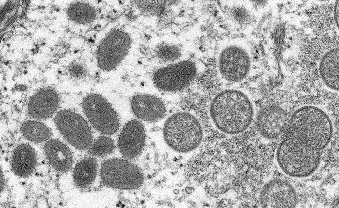 バーレーンは国内初となるサル痘ウイルスの感染を確認し、感染者は隔離された。 （ファイル / AFP）
