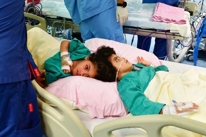 リヤドのキング・アブドゥラー専門小児病院で、17時間に及ぶ複雑な分離手術を受けたエジプト人の双子のサルマとサラ。（提供/KSrelief）