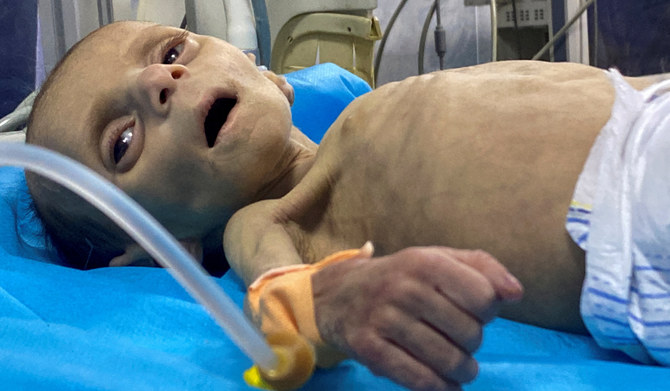 2024年3月26日、ガザ地区北部で、イスラエルとハマスの紛争が続く中、重度の栄養失調に苦しむパレスチナ人幼児レイラ・ジェニードさんが、カマル・アドワン病院で治療を受ける。(REUTERS)
